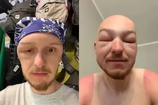 Опухшая голова новосибирца после катания на сапе без шляпы