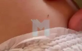 Ребенок в Царицыно пострадал от укуса иксодового клеща