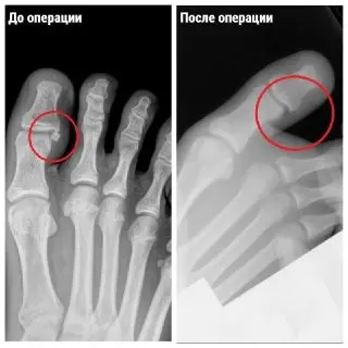 Юного спортсмена прооперировали из-за застарелого перелома пальца