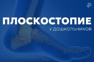 Как распознать плоскостопие у детей: советы ортопеда