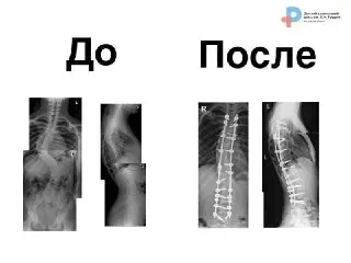 Успешная Операция: Девочка Избавилась От Сколиоза IV Степени