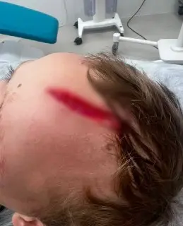 Собака напала на 7-летнего мальчика: серьезные травмы и стресс