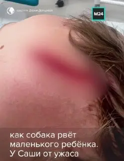 Собачьи атаки в Подмосковье: внук Донцовой и другие пострадавшие