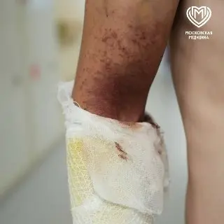 Москвич получил ожоги от борщевика: врачи оказали помощь