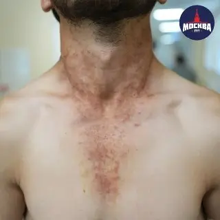 Мужчина в Москве получил ожоги от борщевика и был успешно спасен