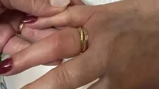 Спасатели помогли женщине снять кольцо с опухшего пальца