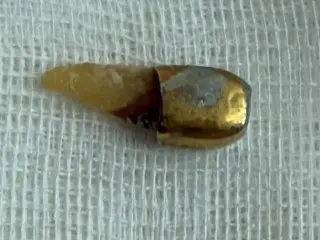 Врачи успешно извлекли зубную коронку из пищевода пожилой женщины